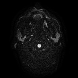Acute superior cerebellar artery territory infarct (Radiopaedia 84104-99358 Axial DWI 65).jpg