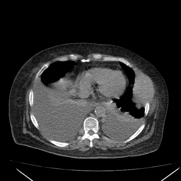 Acute tubular necrosis (Radiopaedia 28077-28334 Axial non-contrast 8).jpg
