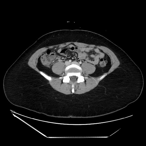 Acute uncomplicated appendicitis (Radiopaedia 73704-84499 Axial C+ portal venous phase 102).jpg