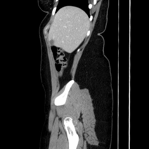 Acute uncomplicated appendicitis (Radiopaedia 73704-84499 Sagittal C+ portal venous phase 60).jpg