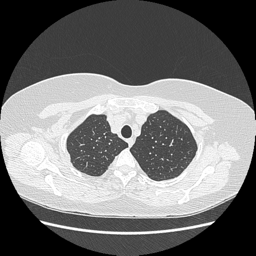 Adenocarcinoma in situ of lung (Radiopaedia 38685-40829 B 41).png