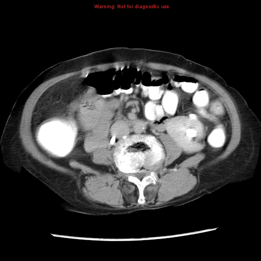 Adenocarcinoma of the colon (Radiopaedia 8191-9039 Axial renal excretory phase 27).jpg