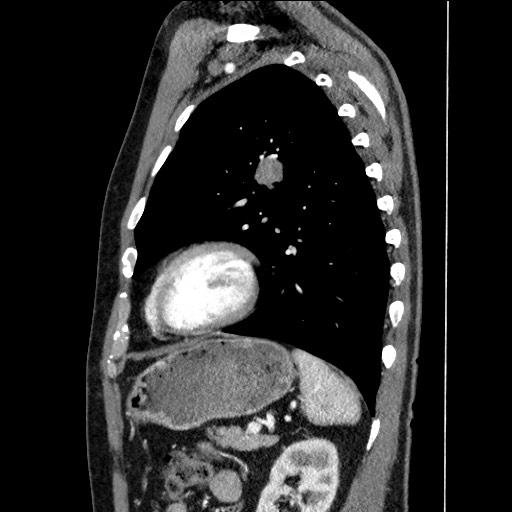 Adenocarcinoma of the lung (Radiopaedia 59871-67325 Sagittal C+ arterial phase 76).jpg