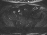 Adenocarcioma of rectum- T1 lesion (Radiopaedia 36921-38546 Axial DWI 23).png
