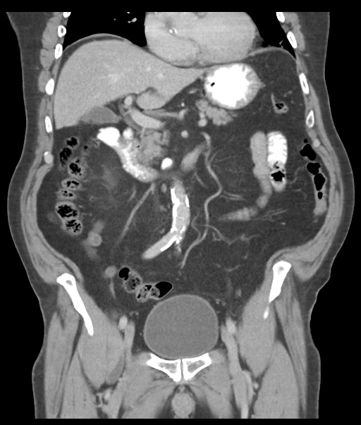 Adenocarcioma of rectum- T1 lesion (Radiopaedia 36921-38547 Coronal C+ portal venous phase 29).png