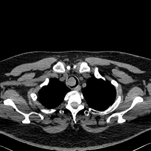 Adenoid cystic carcinoma of the trachea (Radiopaedia 49042-54137 Axial non-contrast 44).jpg