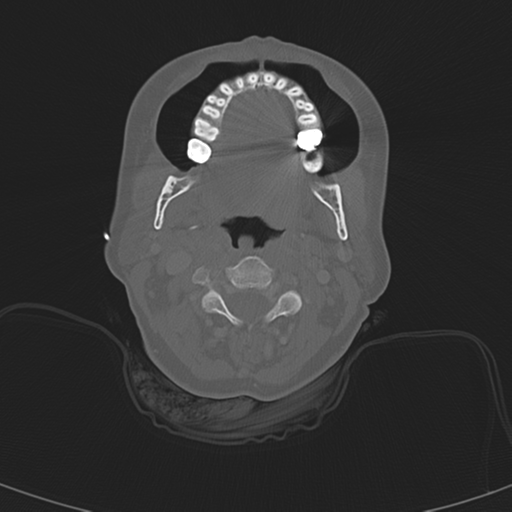 File:Adenoid cystic tumor of palate (Radiopaedia 46980-51518 Axial bone window 33).png