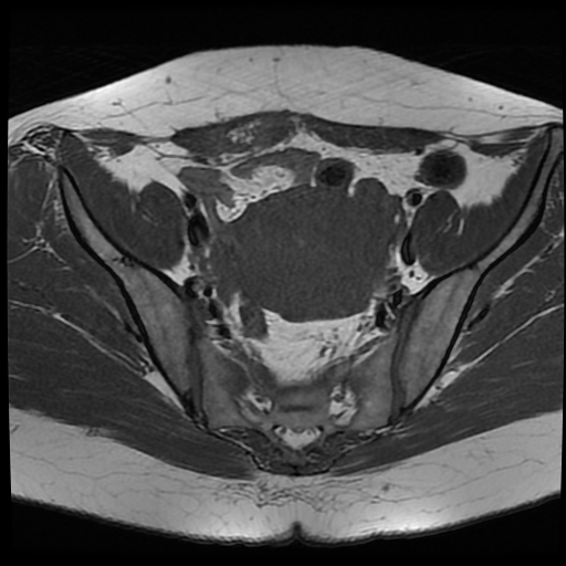 File:Adenomyosis-scar endometriosis (Radiopaedia 65863-75022 Axial T1 12).jpg