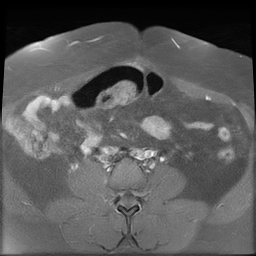 File:Adenomyosis within a didelphys uterus (Radiopaedia 70175-80215 Axial T1 C+ fat sat 8).jpg