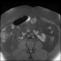 File:Adenomyosis within a didelphys uterus (Radiopaedia 70175-80215 Axial T1 fat sat 4).jpg