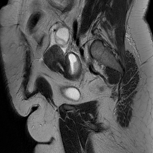 File:Adenomyosis within a didelphys uterus (Radiopaedia 70175-80215 Sagittal T2 27).jpg