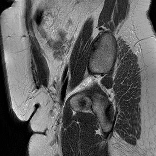 File:Adenomyosis within a didelphys uterus (Radiopaedia 70175-80215 Sagittal T2 5).jpg