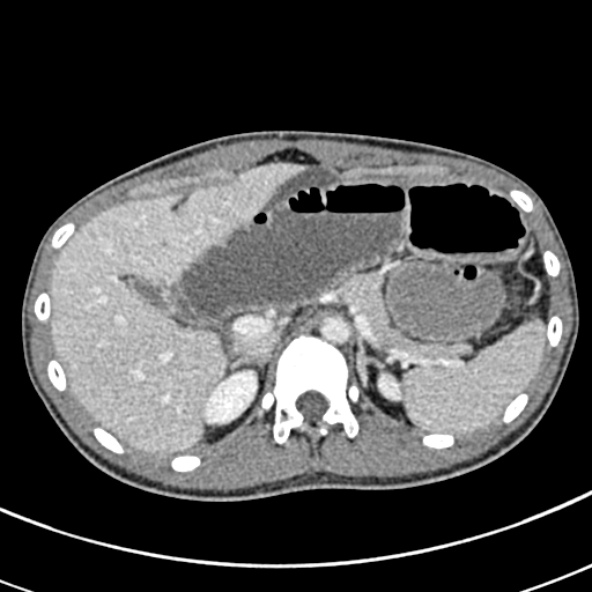 File:Adhesional small bowel obstruction (Radiopaedia 52107-57980 Axial C+ portal venous phase 27).jpg