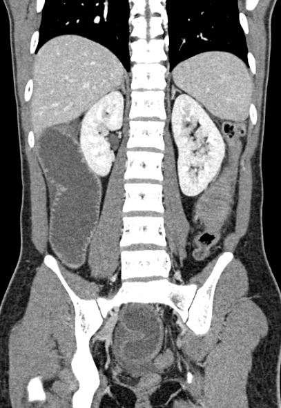 Adhesional small bowel obstruction (Radiopaedia 52107-57980 Coronal C+ portal venous phase 56).jpg