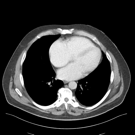 File:Adhesions within abdominal wall hernia (Radiopaedia 58283-65394 Axial C+ portal venous phase 2).png