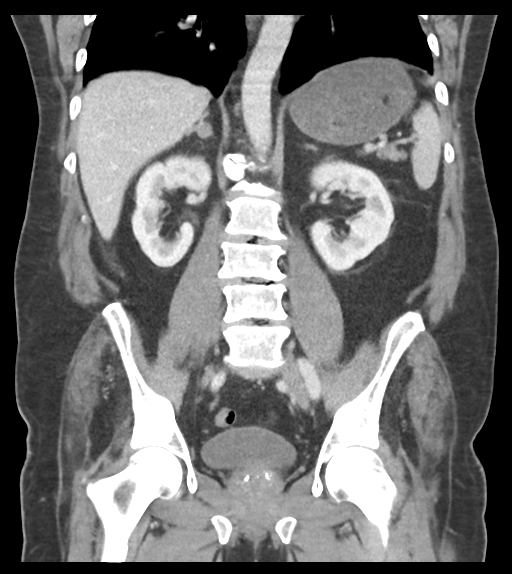 Adhesions within abdominal wall hernia (Radiopaedia 58283-65394 Coronal C+ portal venous phase 45).png