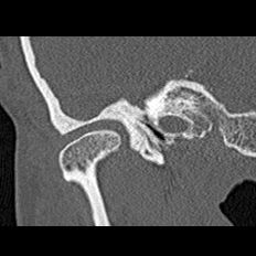 File:Adhesive chronic otitis media (Radiopaedia 14270-14148 Coronal bone window - right 3).jpg