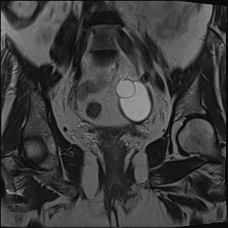 File:Adnexal multilocular cyst (O-RADS US 3- O-RADS MRI 3) (Radiopaedia 87426-103754 Coronal T2 18).jpg