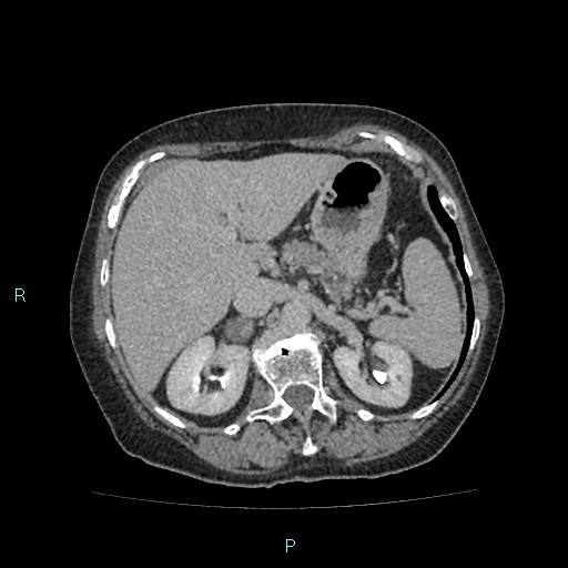 File:Adrenal collision tumor (ACT) (Radiopaedia 48462-53379 Axial C+ delayed 18).jpg