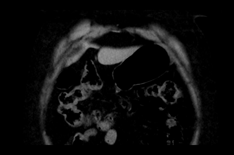 Adrenal cortical carcinoma (Radiopaedia 64017-72769 Coronal non-contrast 10).jpg