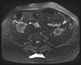 Adrenal cortical carcinoma (Radiopaedia 64017-72770 Axial DWI 79).jpg