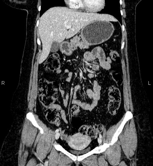 Adrenal cortical carcinoma (Radiopaedia 84882-100379 Coronal C+ portal venous phase 23).jpg