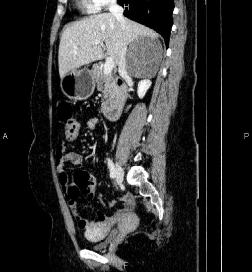 File:Adrenal cortical carcinoma (Radiopaedia 84882-100379 Sagittal C+ portal venous phase 37).jpg