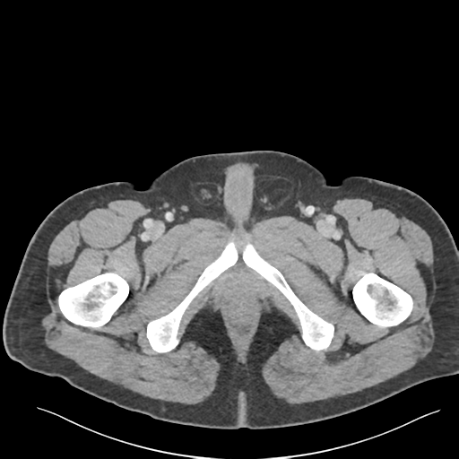 Adrenal cyst (Radiopaedia 45625-49777 Axial C+ portal venous phase 107).png