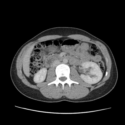 Adrenal cyst (Radiopaedia 64869-73813 Axial C+ portal venous phase 36).jpg