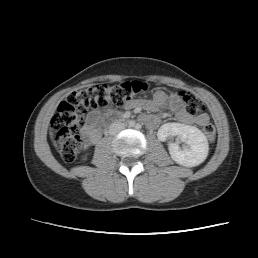Adrenal cyst (Radiopaedia 64869-73813 Axial C+ portal venous phase 39).jpg