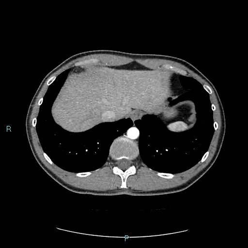 Adrenal cystic lymphangioma (Radiopaedia 83161-97534 Axial C+ arterial phase 15).jpg