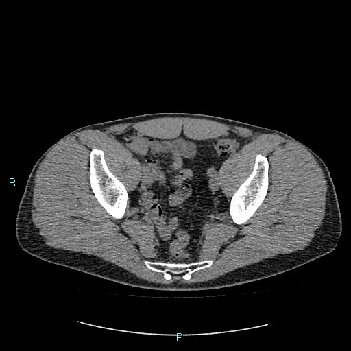 Adrenal cystic lymphangioma (Radiopaedia 83161-97534 Axial non-contrast 84).jpg