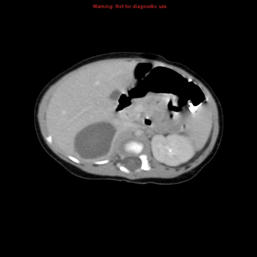 File:Adrenal hemorrhage (Radiopaedia 9390-10077 Axial C+ portal venous phase 8).jpg