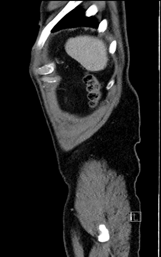 Adrenal lymphoma (Radiopaedia 73730-84529 Sagittal C+ portal venous phase 105).jpg
