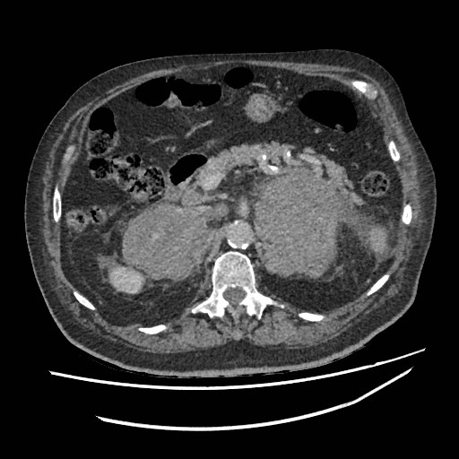 Adrenal lymphoma (Radiopaedia 84145-99415 Axial C+ portal venous phase 38).jpg