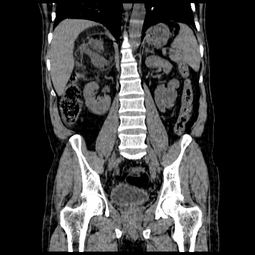 File:Adrenal myelolipoma (Radiopaedia 41843-44834 Coronal non-contrast 10).jpg