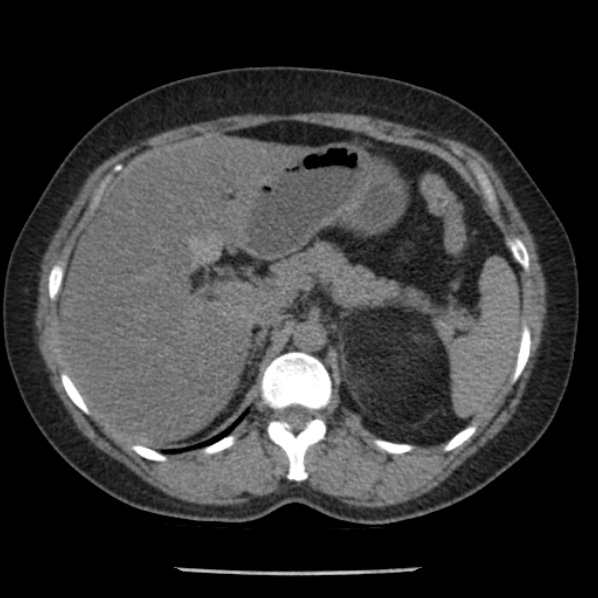 Adrenal myelolipoma (Radiopaedia 43401-46759 Axial non-contrast 25).jpg