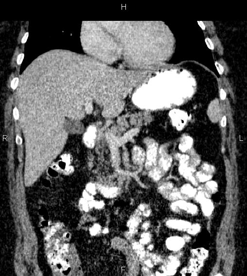 Adrenal myelolipoma (Radiopaedia 84319-99617 Coronal renal cortical phase 31).jpg