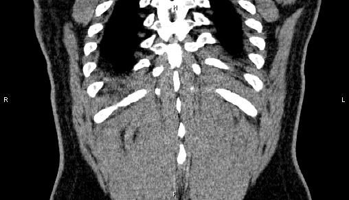 Adrenal myelolipoma (Radiopaedia 84321-99619 Coronal non-contrast 71).jpg