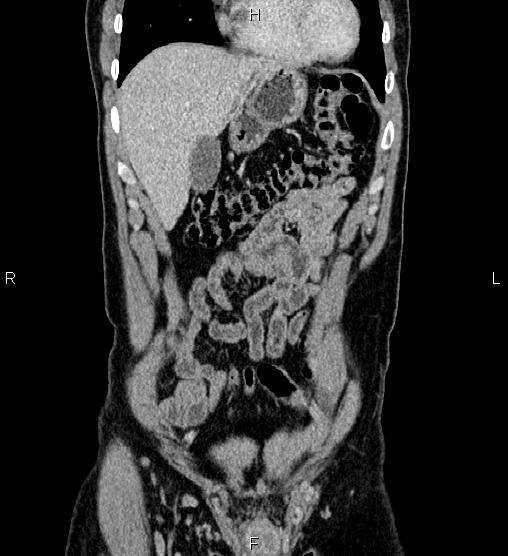 File:Adrenal myelolipoma (Radiopaedia 87794-104246 Coronal renal cortical phase 13).jpg