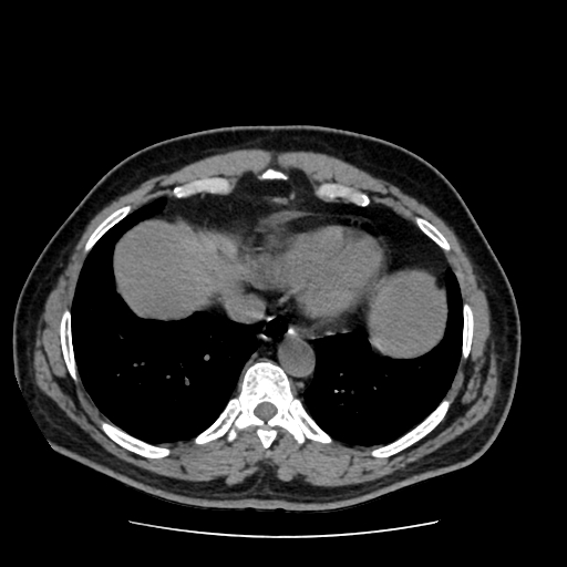 Adrenal myelolipoma and beaver tail liver (Radiopaedia 86201-102193 Axial non-contrast 26).jpg