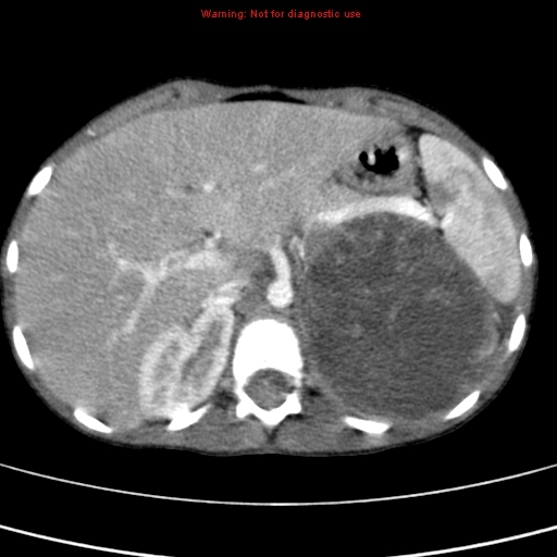 File:Adrenocortical carcinoma (Radiopaedia 9449-10131 Axial C+ portal venous phase 15).jpg