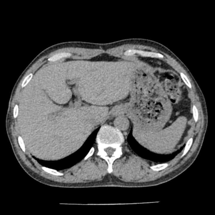 Airway foreign body in adult (Radiopaedia 85907-101779 Axial liver window 191).jpg