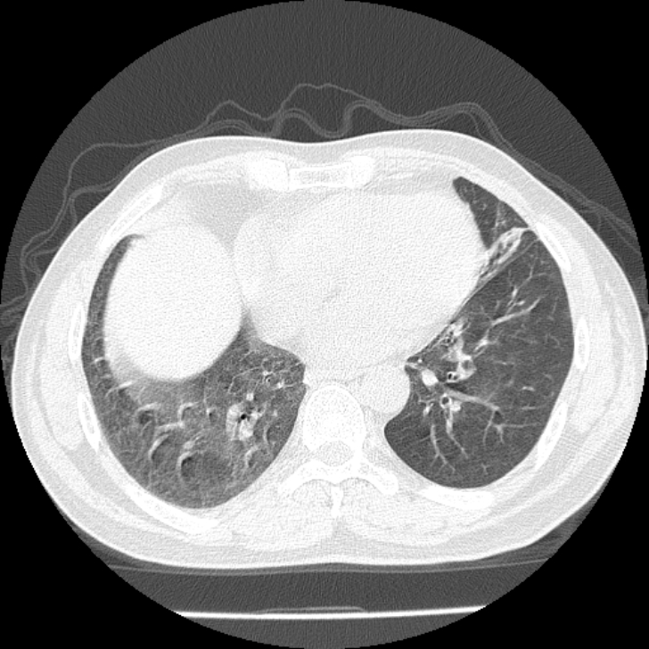 Airway foreign body in adult (Radiopaedia 85907-101779 Axial lung window 127).jpg