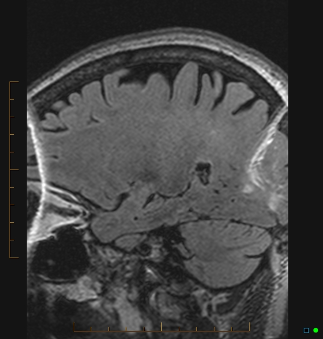 Aliasing artifact causing a spurious cerebellar lesion (Radiopaedia 48783-53810 Sagittal FLAIR 84).jpg