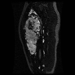 Alveolar soft part sarcoma (Radiopaedia 64501-73678 D 81).jpg