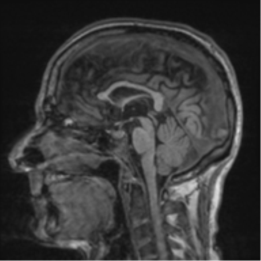File:Alzheimer's disease- with apraxia (Radiopaedia 54763-61011 Sagittal T1 36).png