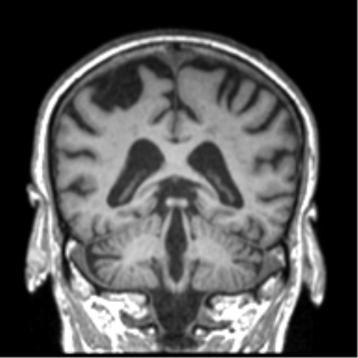 Alzheimer disease and cerebral amyloid angiopathy (Radiopaedia 64234-73011 Coronal T1 21).png