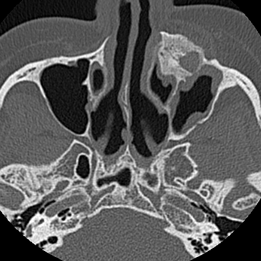 File:Ameloblastic fibro-odontoma (Radiopaedia 18843-18780 C 15).jpg