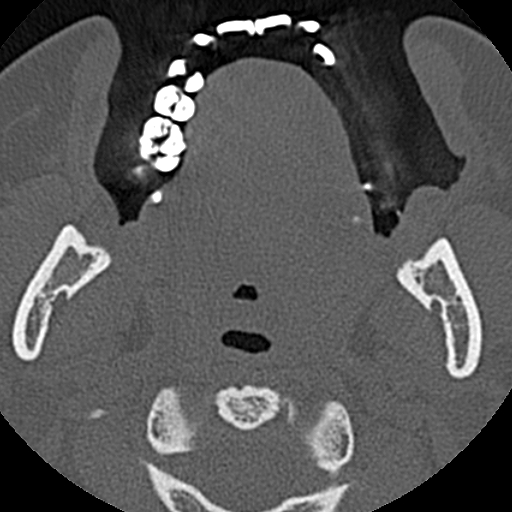 File:Ameloblastic fibro-odontoma (Radiopaedia 18843-18780 C 57).jpg
